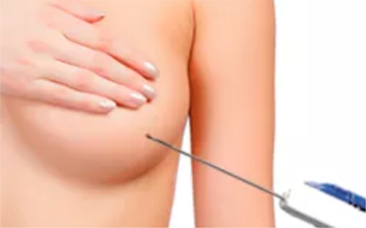 Biopsia percutánea de la mama guiada por ultrasonido | Imágenes | Clínica Montesur
